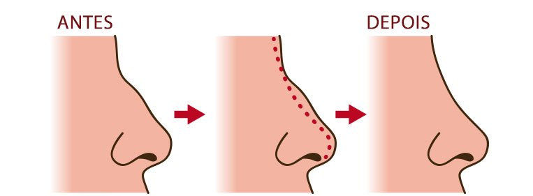 P S Operat Rio Rinoplastia Cuidados B Sicos Dream Plastic