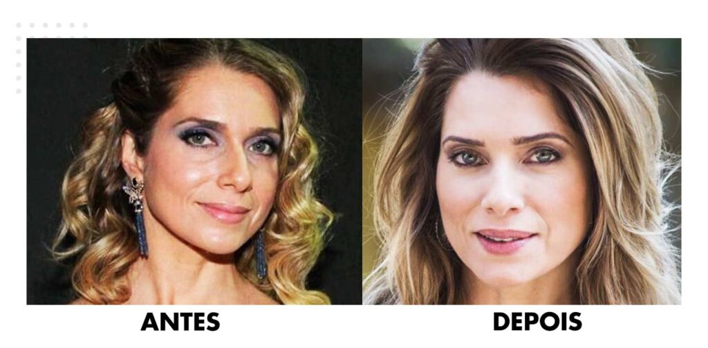 Lifting Rosto Antes E Depois Veja Fotos Dream Plastic