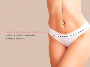 Abdominoplastia em âncora Guia completo Dream Plastic