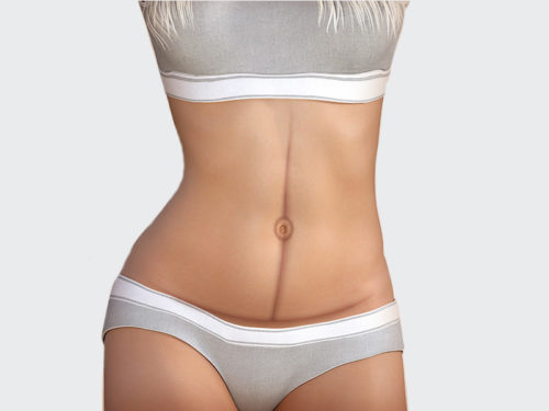 Abdominoplastia Tudo o que você precisa saber Dream Plastic