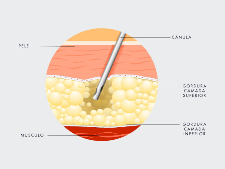 Lipo Hd Tudo Sobre A Lipoaspira O Lad De Alta Defini O