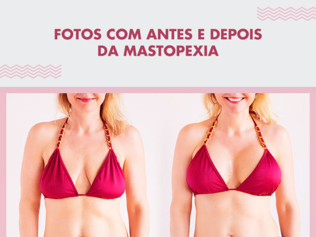 Mastopexia Antes E Depois Fotos Dream Plastic