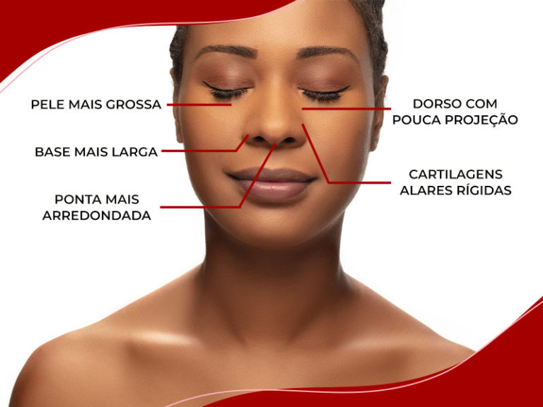 Nariz Negroide Pre O Da Rinoplastia E Como Fica O Antes E Depois