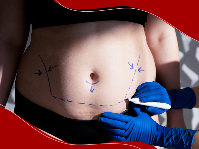Imagem de pré-operatório de riscos na barriga da cliente, antes da cirurgia de abdominoplastia