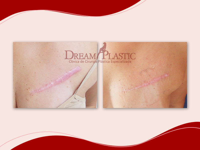 Antes e depois da cirurgia de reparo de cicatriz de paciente da Dream Plastic