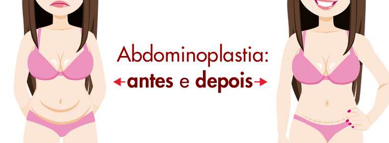 Abdominoplastia antes e depois Conheça Dream Plastic