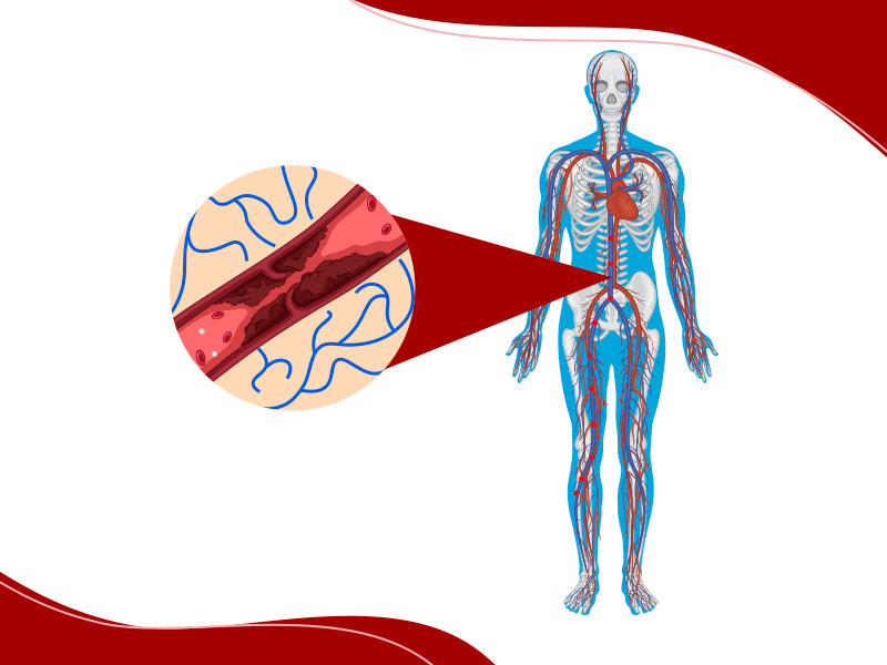Ilustração que mostra o que é embolia pulmonar, com os êmbolos indo da perna em direção ao pulmão