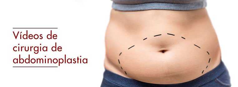 Vídeos de cirurgia de abdominoplastia| Confira – Dream Plastic