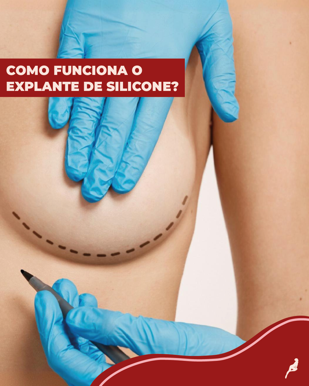 Seios com a marcação de caneta para fazer o explante de silicone