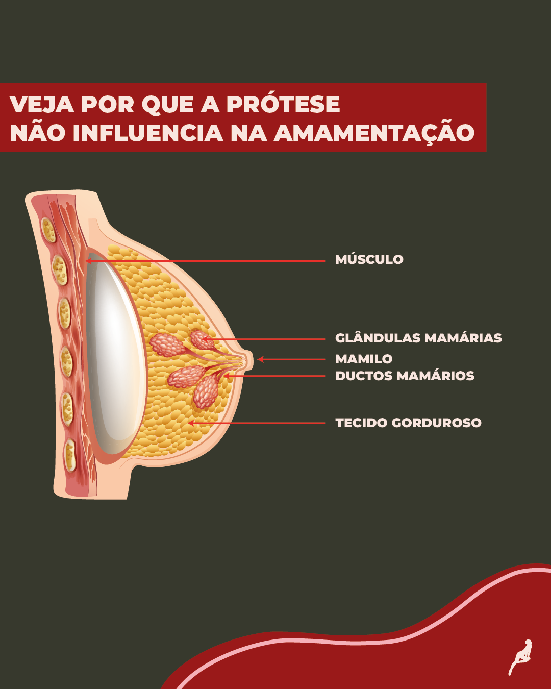 Quem tem silicone pode amamentar normalmente? Ilustração que mostra o por que a prótese não influencia na amamentação, a prótese fica atrás de toda a estrutura responsável pela produção do leite.