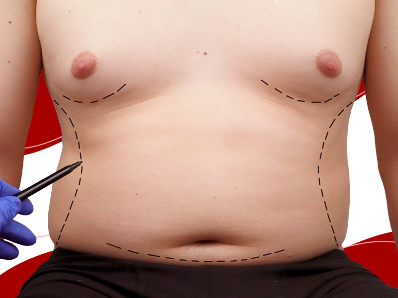 abdominoplastia-masculina cirurgia marcações