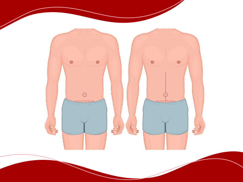 abdominoplastia-masculina cicatriz comparação