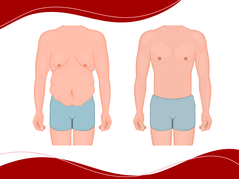 abdominoplastia-masculina antes-e-depois comparação