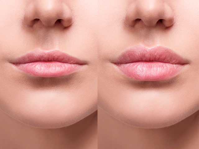 Preenchimento Labial Como Aumentar Os Lábios Dream Plastic