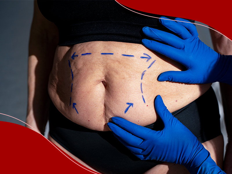 Mãos com luvas azuis fazendo as marcações na barriga de mulher com top e calcinha preta, para mostrar o que é abdominoplastia reversa