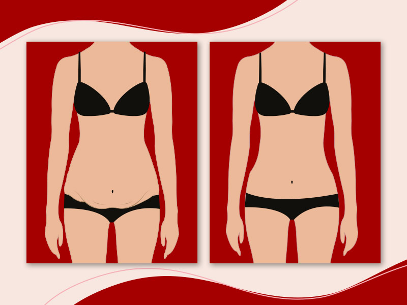 Ilustração com duas imagens mostrando o antes e depois de uma paciente que fez abdominoplastia