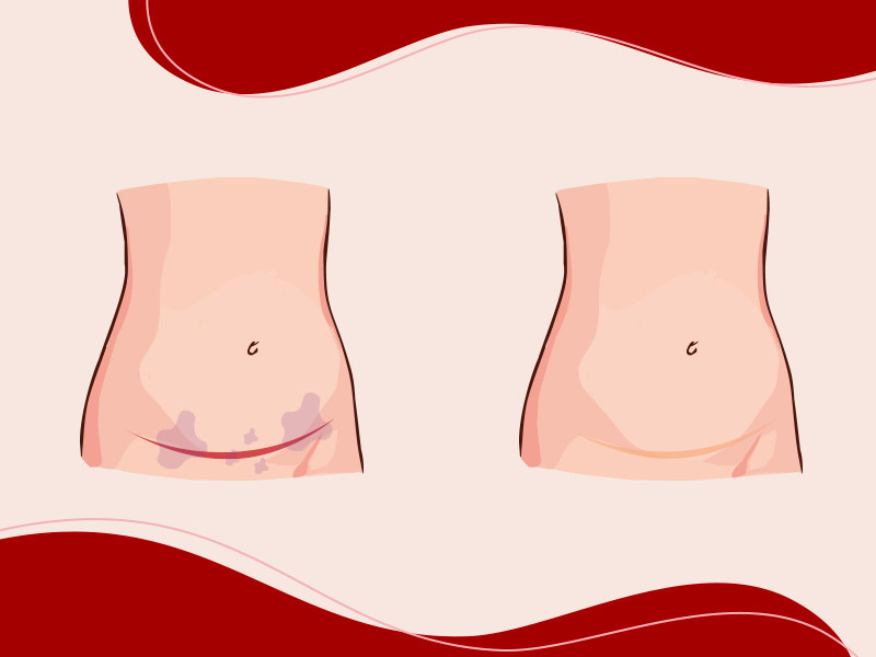 A ilustração mostra como fica a cicatriz da abdominoplastia