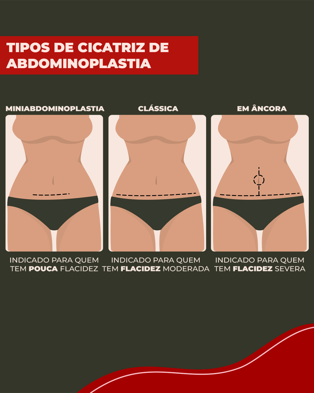 Ilustração que mostra os tipos de cicatriz de abdominoplastia