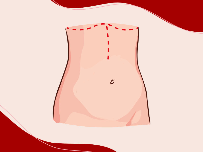 Ilustração que mostra como fica a cicatriz da abdominoplastia reversa