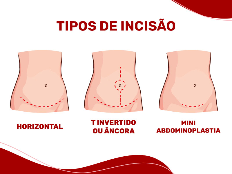 Ilustração que mostra os principais tipos de incisão da abdominoplastia
