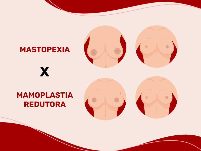 Mastopexia ou Mamoplastia redutora