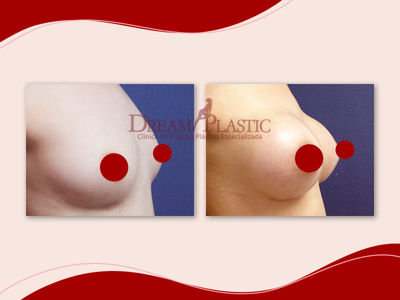 Antes e depois da mamoplastia de aumento de paciente da Dream Plastic