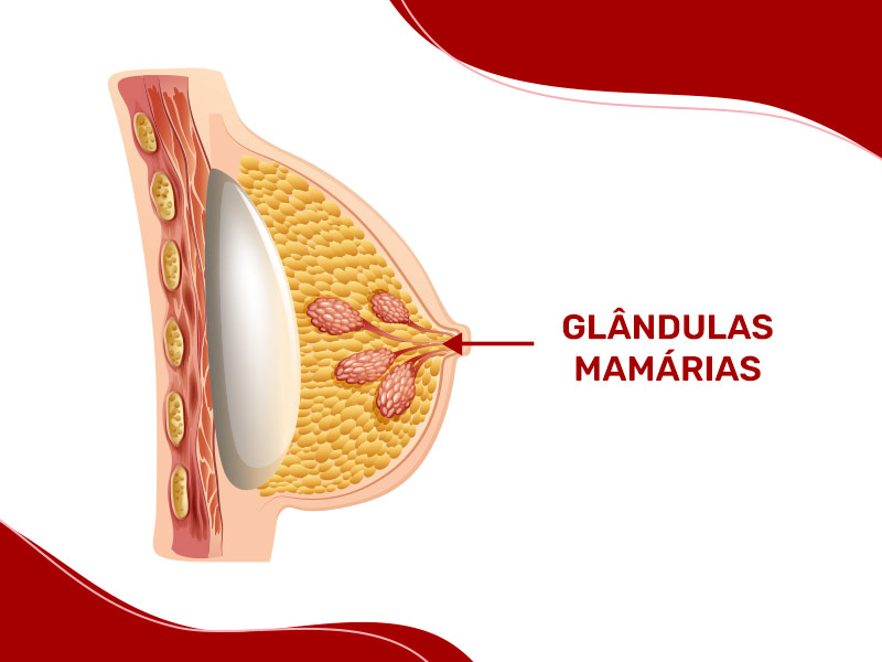 Ilustração que mostra como fica o implante dentro do seio, atrás das glândulas mamárias, ou seja, ele não atrapalha em nada o autoexame 
