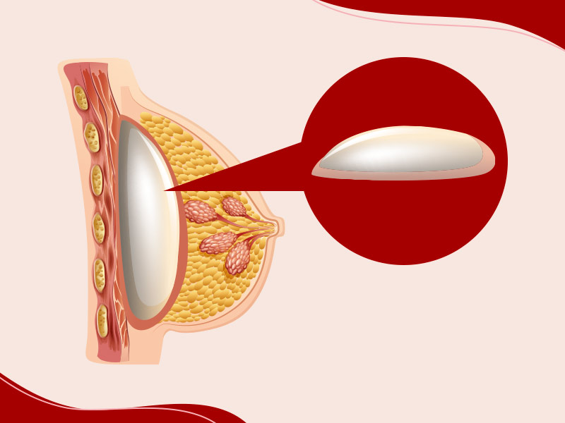 Ilustração que mostra como a prótese redonda fica dentro do corpo