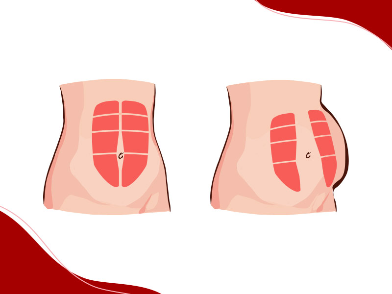 Ilustração que mostra uma barriga normal e uma com diástase, para mostrar o que é diástase na gravidez