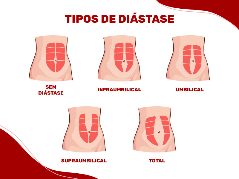 Ilustração que mostra como fica o músculo abdominal em cada um dos tipos de diástase