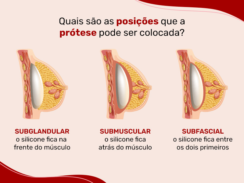 Ilustração que mostra as três posições que a prótese pode ser colocada, subglandular, submuscular, subfascial.