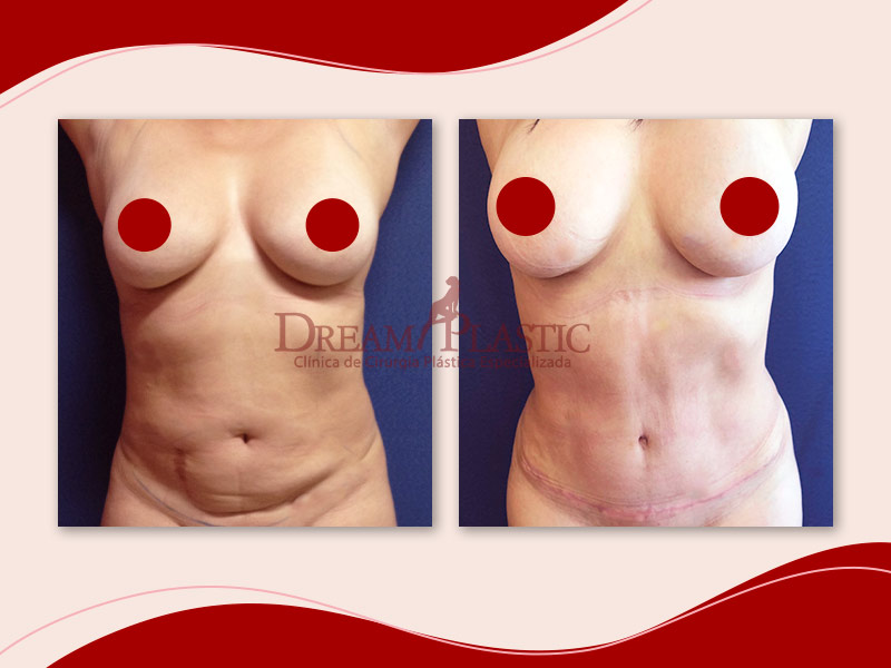 Antes e depois da abdominoplastia com lipo HD