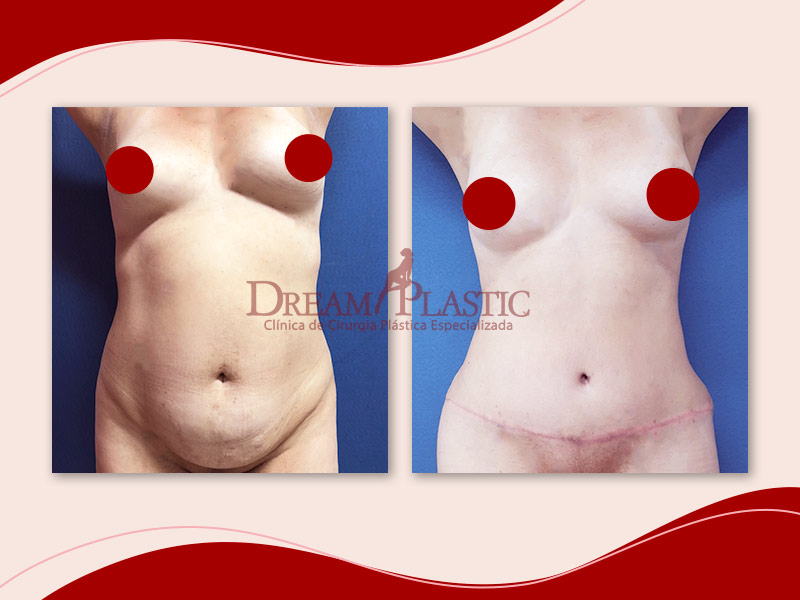 antes e depois da abdominoplastia com lipo