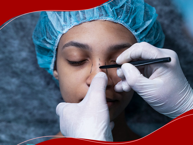 Médico fazendo as marcações no nariz de paciente, antes da rinoplastia para nariz torto.