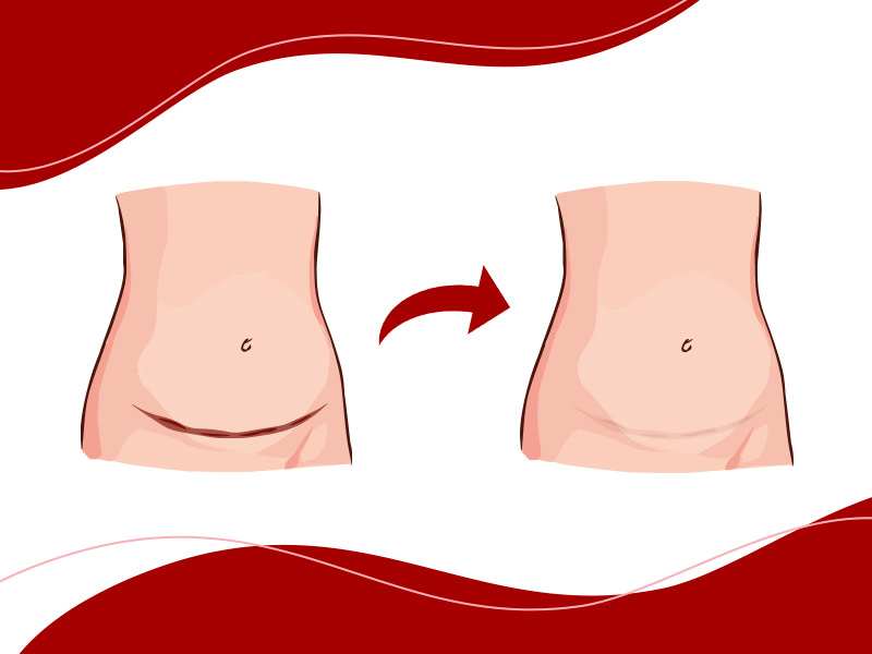 Ilustração que mostra o antes e depois da carboxiterapia em cicatriz de queloide na barriga