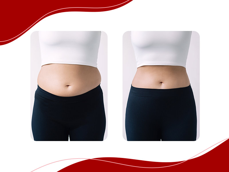 Antes e depois do endolifting abdominal