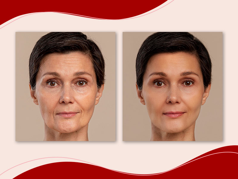 Antes e depois do microagulhamento facial