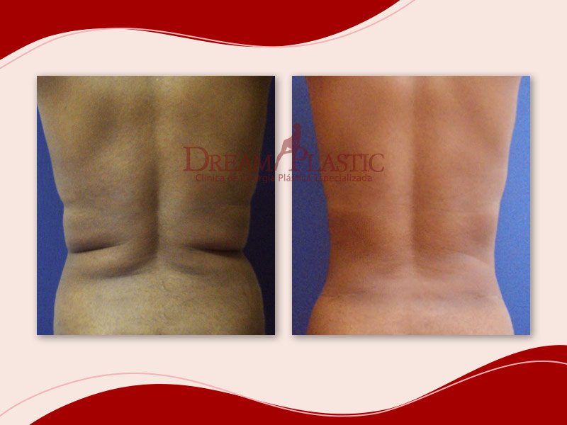 Antes e depois da cirurgia para remover gordura das costas de paciente da Dream Plasti