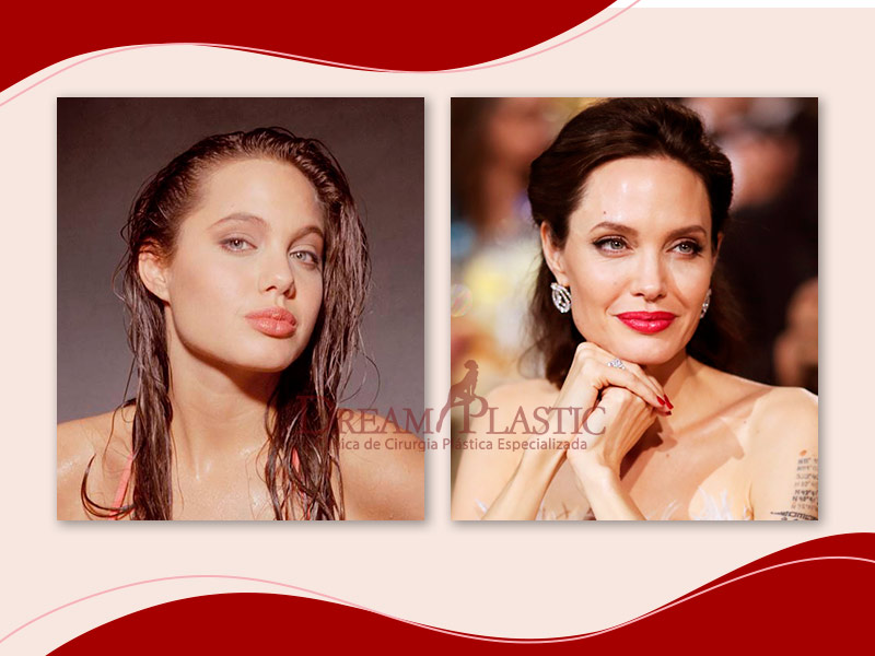 Resultado da bichectomia da atriz Angelina Jolie