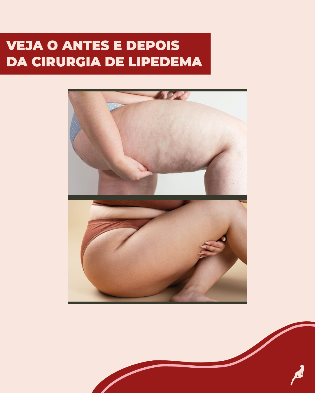 Antes e depois da cirurgia de lipedema Como fica o antes e depois do tratamento de lipedema?
