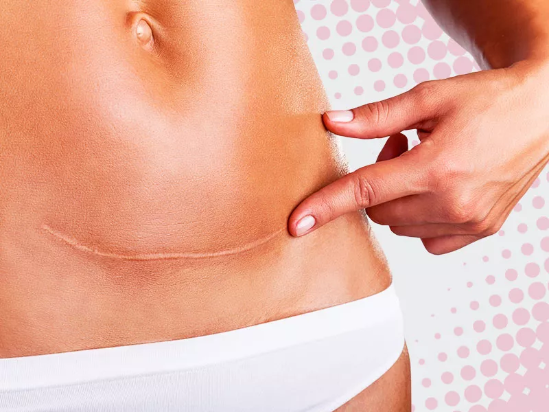 Uma moça com o dedo apontado para a cicatriz da abdominoplastia, de calcinha branca 