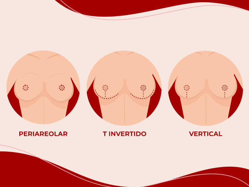 Ilustração que mostra os tipos de incisões mais usadas na mamoplastia redutora