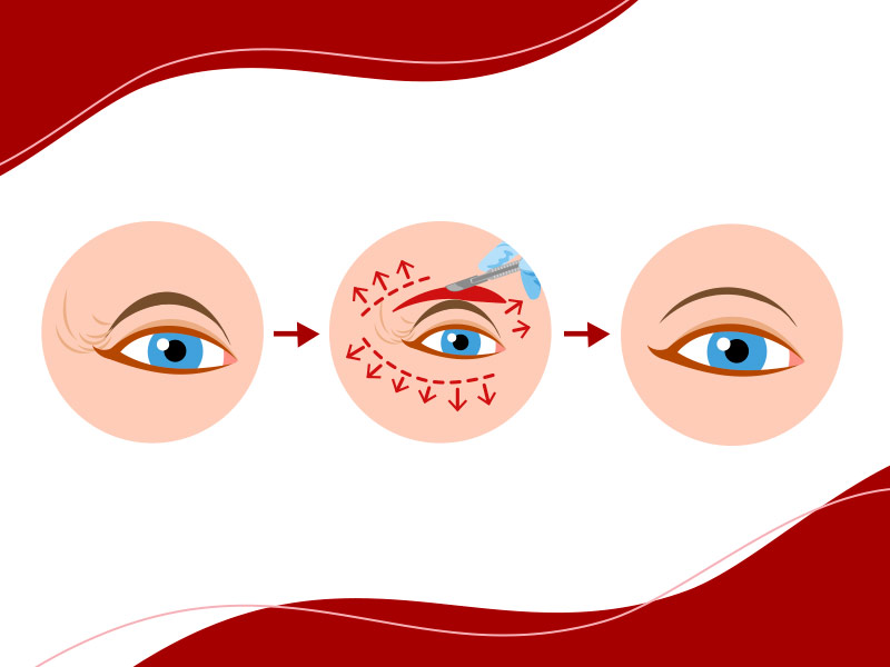 Ilustração que mostra como é feita a cirurgia para ptose palpebral