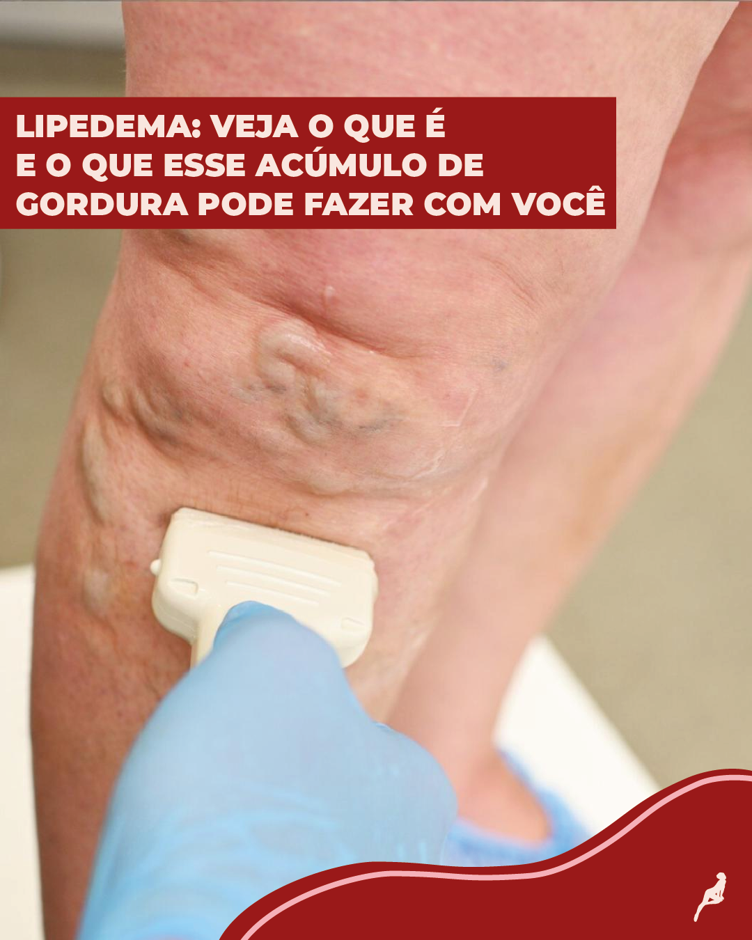O que é o acúmulo de gordura lipedema? O que é lipedema?