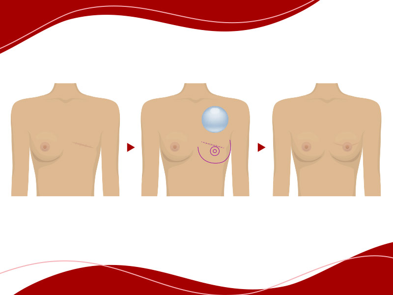 cirurgia plástica reparadora de mama, como funciona