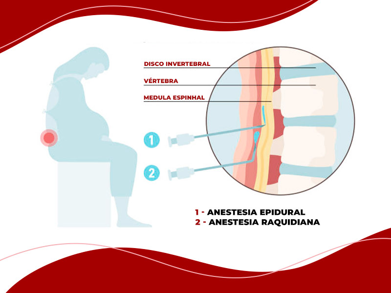 Ilustração que mostra onde a anestesia epidural e raquidiana são injetados