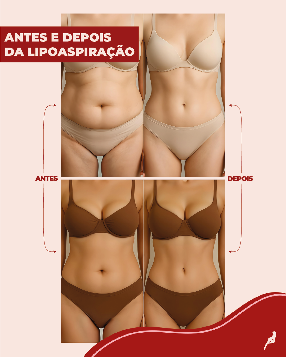 Veja os resultados da lipoaspiração real em diferentes tipos de corpo Comparação visual de antes e depois da lipoaspiração em duas pacientes, com redução de gordura no abdômen, cintura e flancos