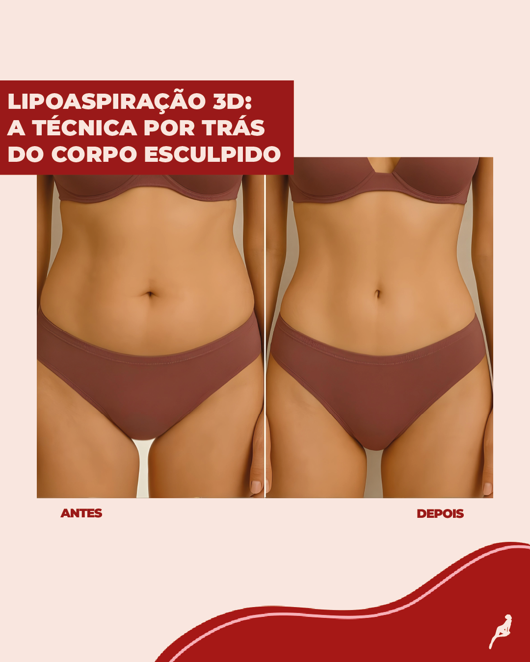 O que muda na lipoaspiração 3D em relação à tradicional? Resultado da lipoaspiração 3D mostrando definição corporal tridimensional em paciente com baixa gordura localizada