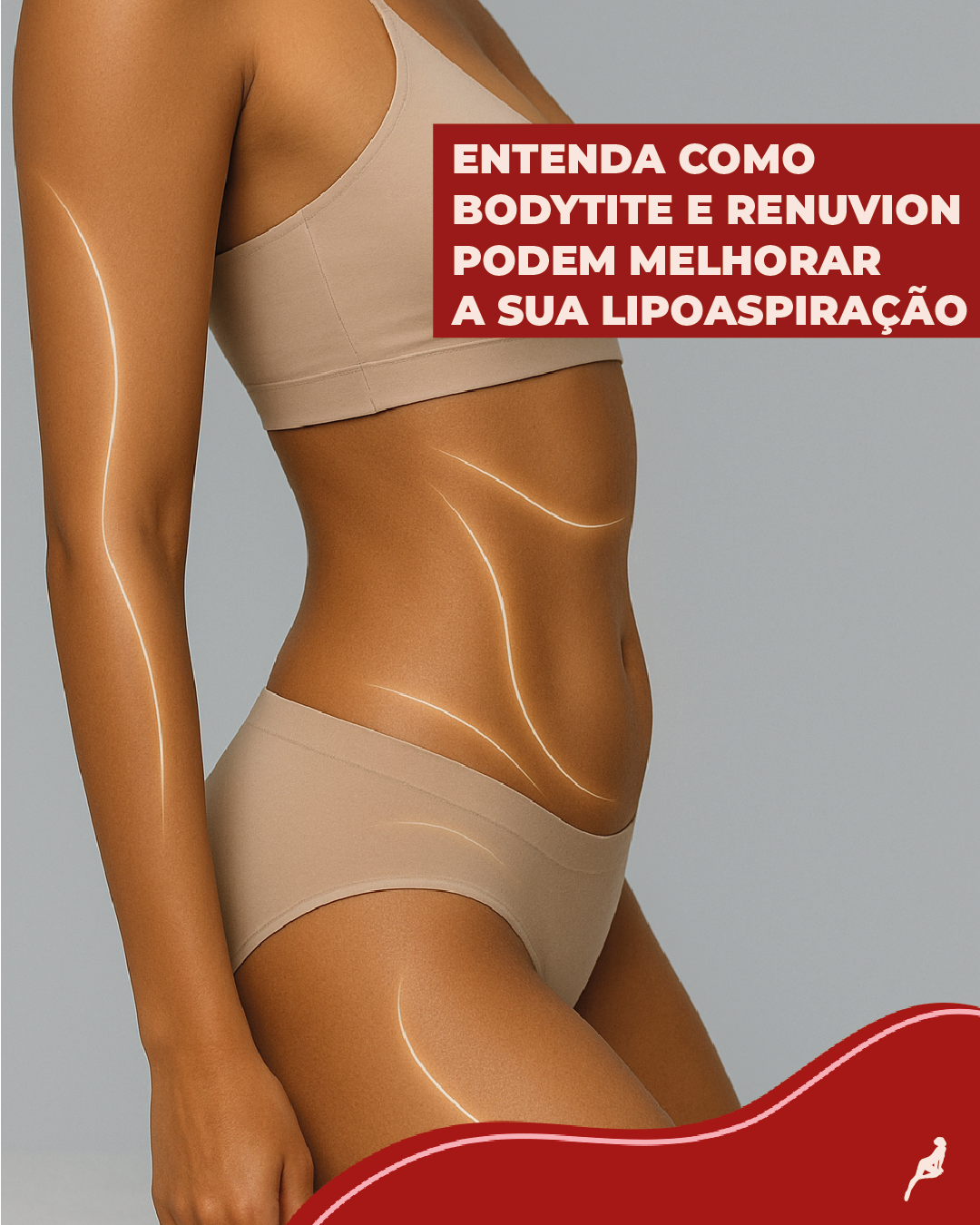 Como Renuvion e BodyTite atuam no resultado da lipo Representação do uso de tecnologias Renuvion e BodyTite para melhorar os resultados da lipoaspiração com foco em retração de pele