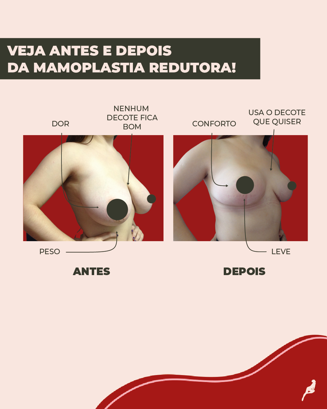 Como é o antes e depois da mamoplastia redutora? Antes e depois da mamoplastia redutora de uma paciente da clínica Dream Plastic